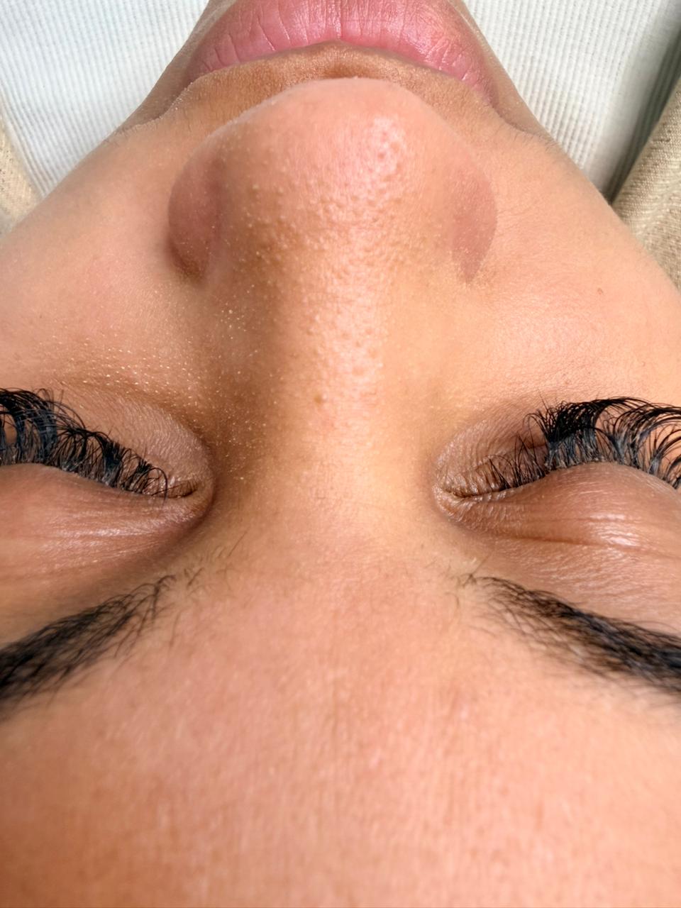 Antes do procedimento de Limpeza de pele