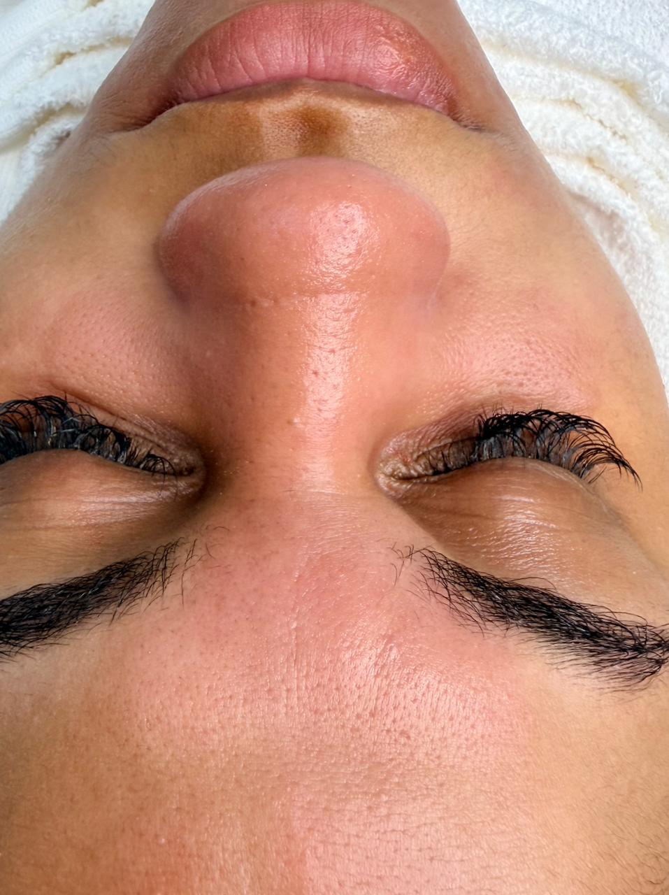 Depois do procedimento de Limpeza de pele